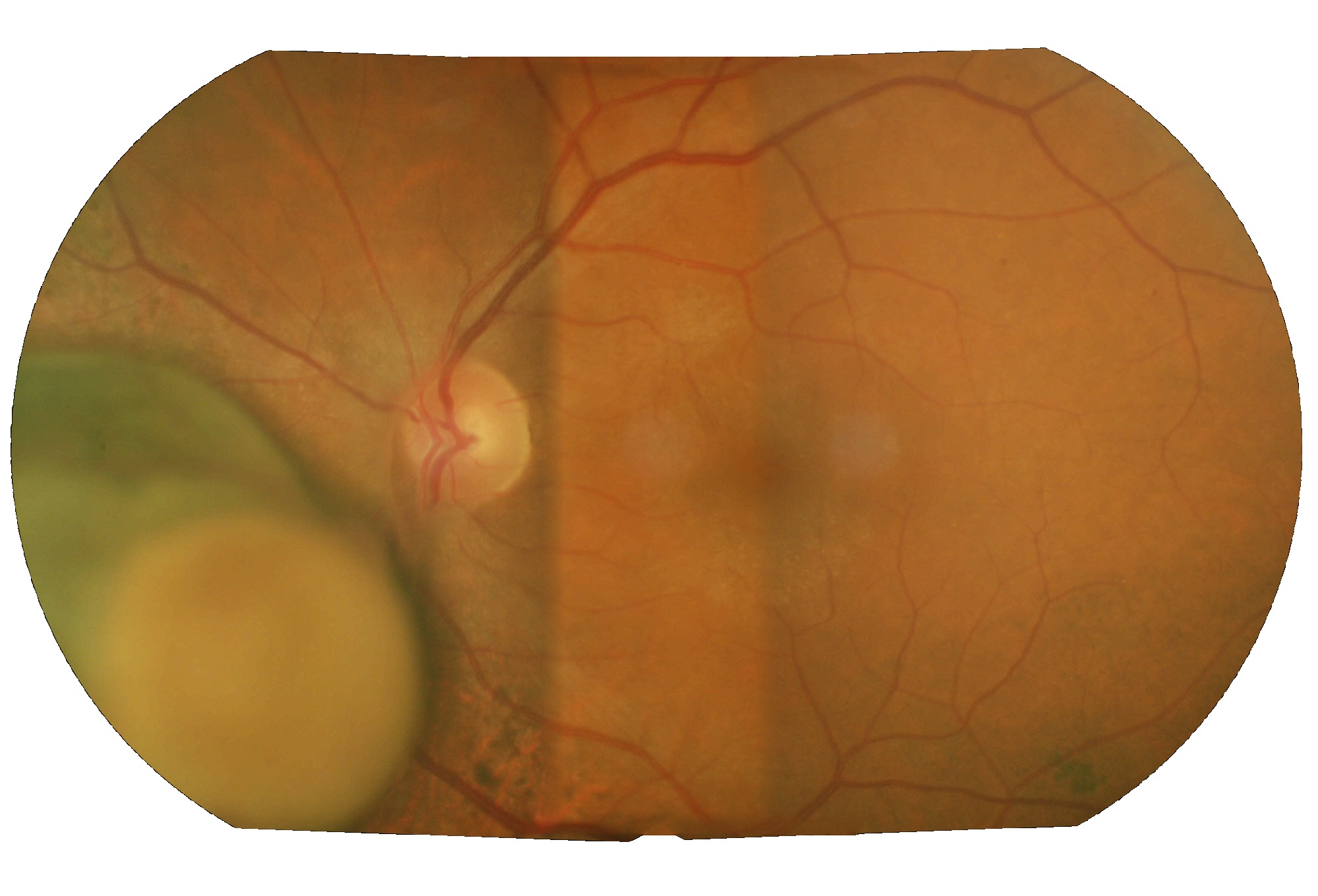 Ripetizione in retina di linfoma o Melanoma